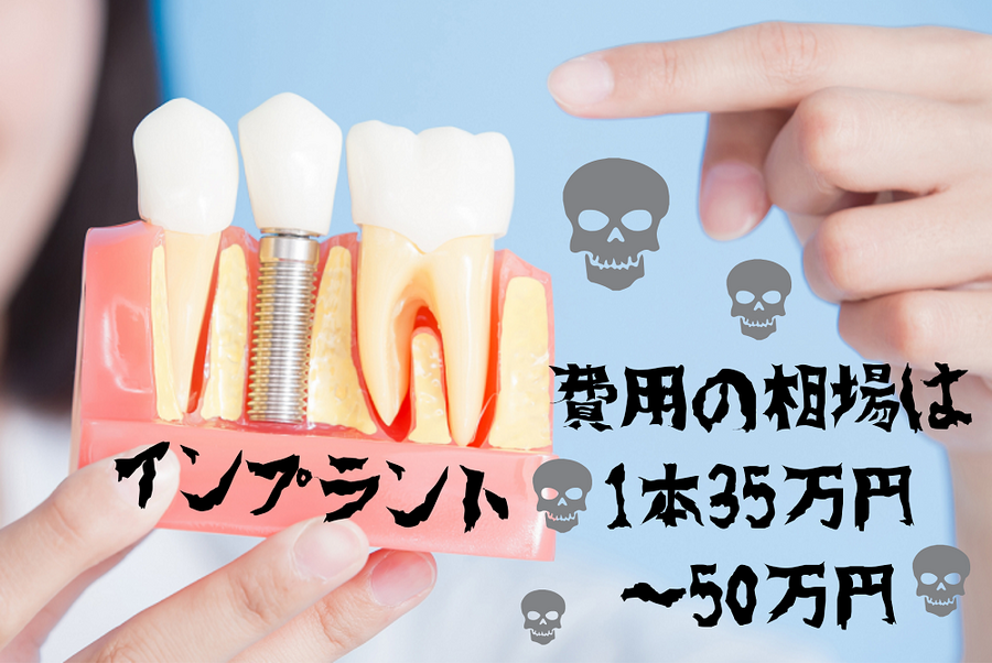 インプラントは高い