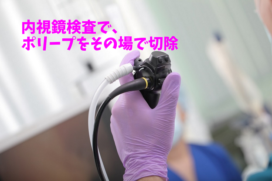 内視鏡検査で、ポリープをその場で切除