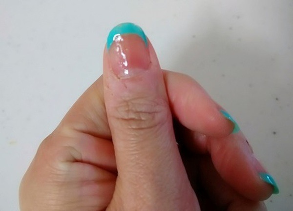 ゆっくりと絆創膏を剥がしUVライトで硬化